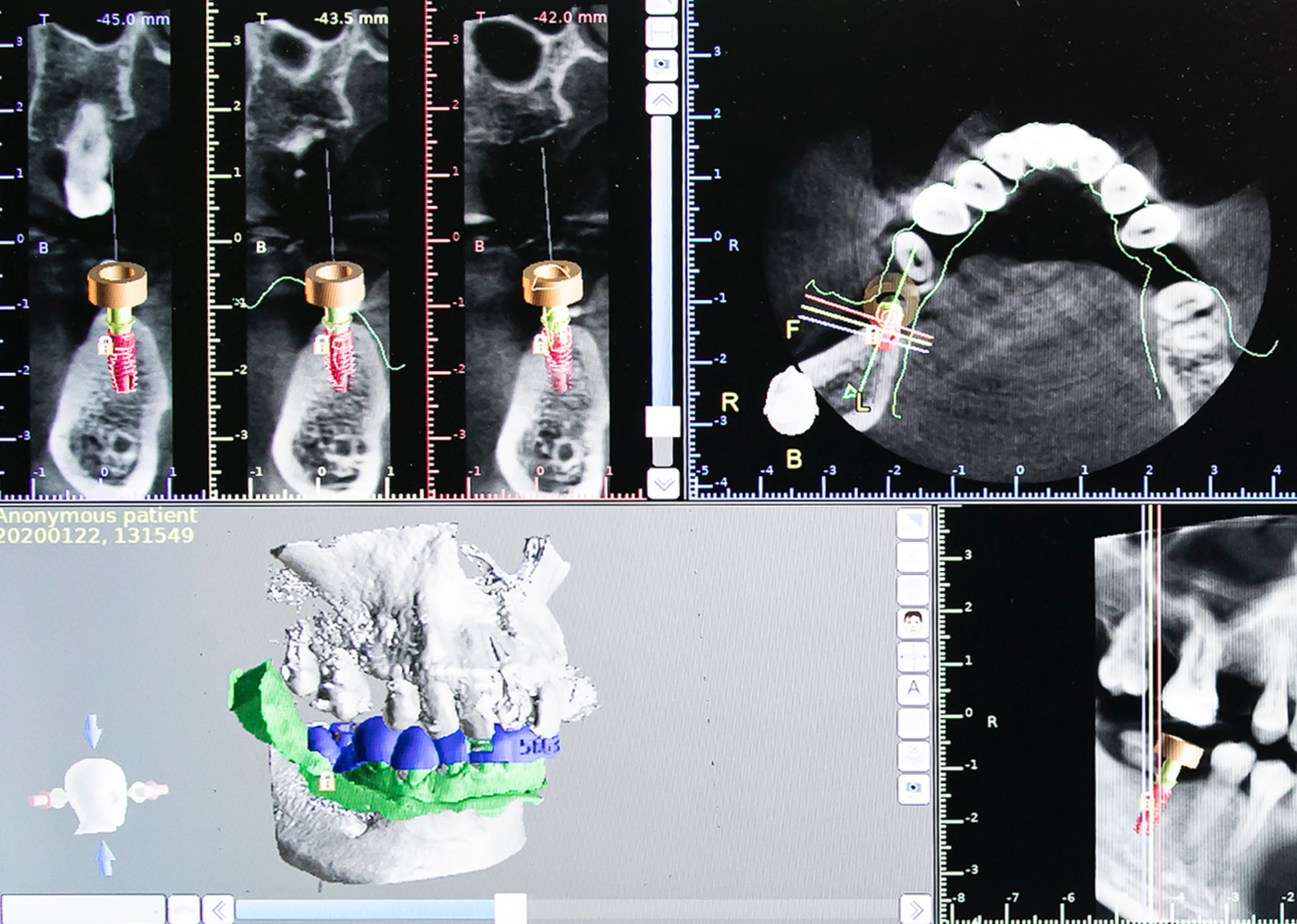 ALL-on-4 オールオンフォー!